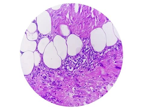 Premium Photo Photomicrograph Of Granulomatous Tissue Histology