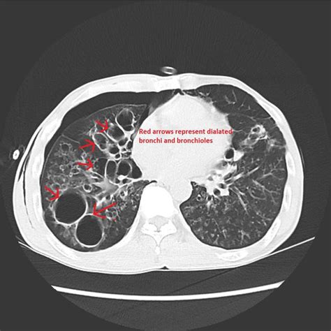 CT Findings In Bronchiectasis MEDizzy