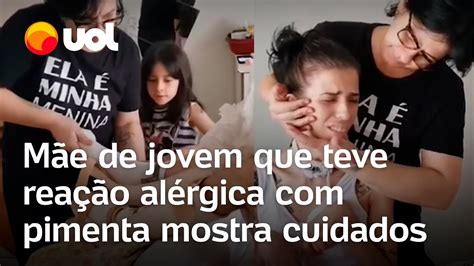 M E De Jovem Que Teve Rea O Al Rgica Ap S Cheirar Pimenta Mostra