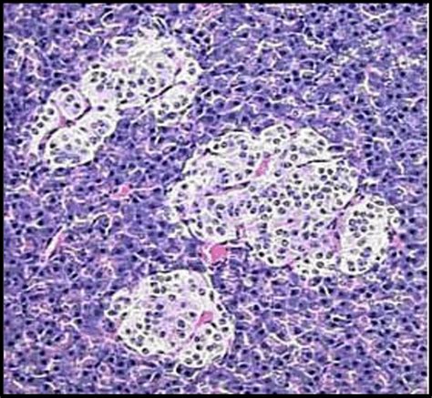 Aspects histologiques des tumeurs neuroendocrines pancréatiques bien