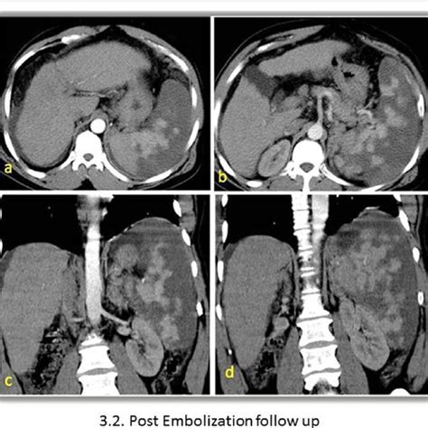 Follow Up Abdominal CT Late Arterial Phase A B Axial Images C D