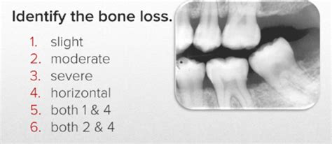 Oral Radiology Exam 2 Practice Questions Flashcards Quizlet