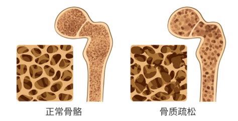 健康你我他 喝汽水会导致骨质疏松喝骨头汤就能预防世界骨质疏松日来了这些你都了解吗