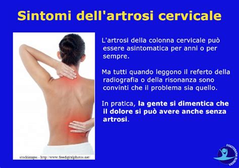 Artrosi Cervicale I Sintomi Reali E La Terapia Pi Efficace