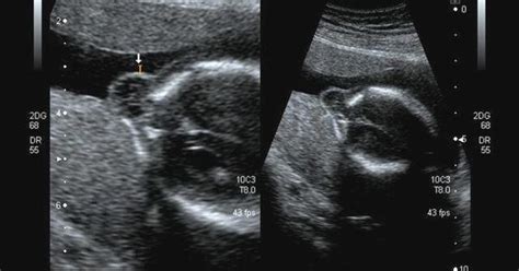 Occipital Meningocele With Encephalocele Ultrasound Notes Pinterest