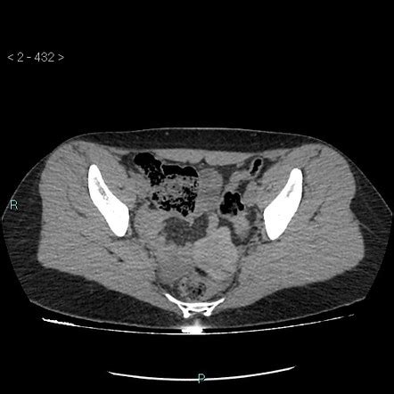 Ovarian Torsion Radiology Reference Article Radiopaedia Org