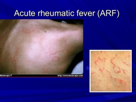 Rheumatic Fever Rash