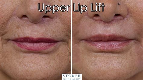 Upper Lip Lift Los Angeles Plastic Surgeon Dr David Stoker