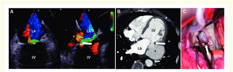 A Biplane Transoesophageal Echocardiography Of The Mitral Valve B