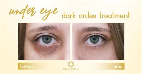 Dark Circles under Your Eyes? Dermal Fillers Can Help - Dr. Sunny ...