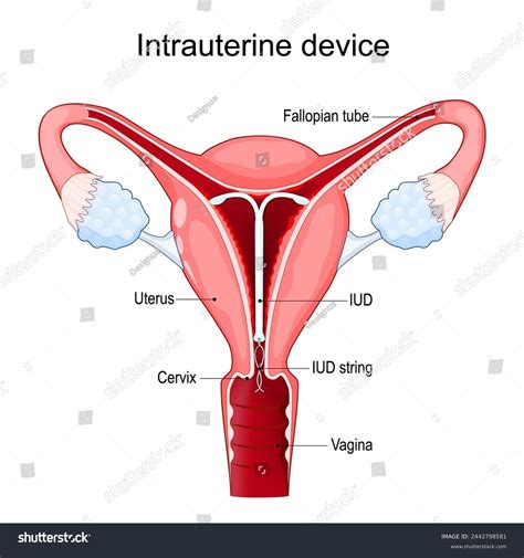 7 Insertion Intrauterine Contraceptive Device Iud Stock Vectors and