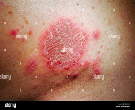 Nummular eczema Stock Photo - Alamy