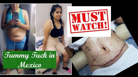 Tummy Tuck Lipo And Bbl In Mexico Recovery Story Time Youtube