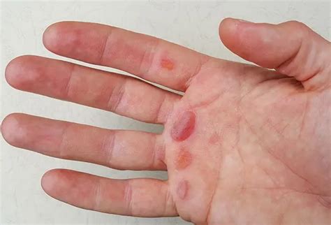 What Causes Blisters And How To Get Rid Of Them 德赢与ac米兰