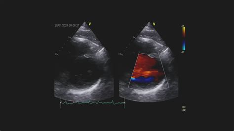 Echokardiografia Od Podstaw Przypadek Polpharma Dla Ciebie