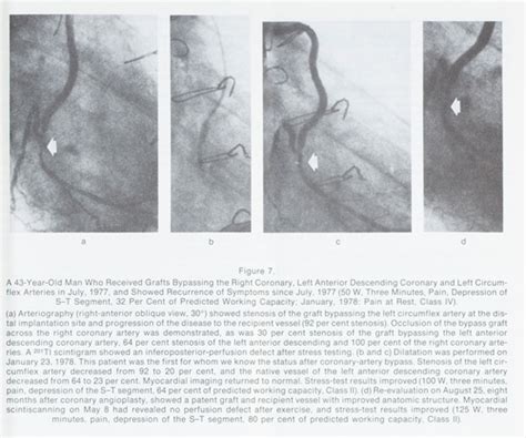 Nonoperative Dilatation Of Coronary Artery Stenosis Percutaneous