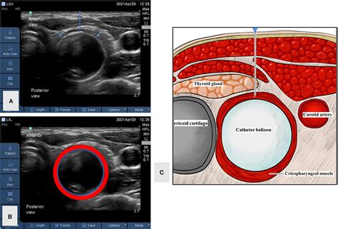 Frontiers Case Report A Case Of Novel Treatment For Retrograde