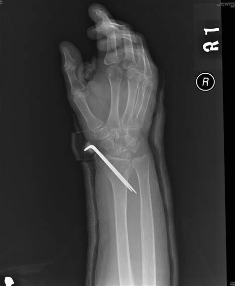 Distal Radius Fracture Kapandji Intrafocal Pinning Technique