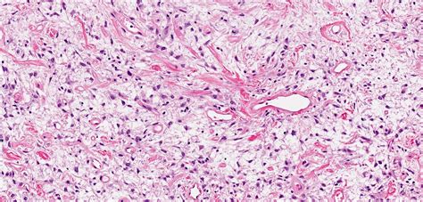 Pathology Outlines Solitary Fibrous Tumor