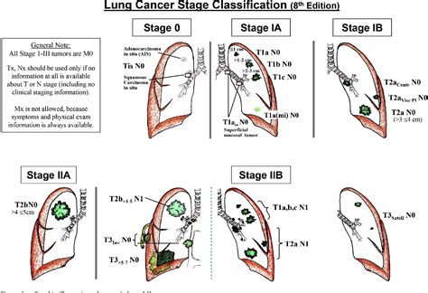 Stages Of Lung Cancer