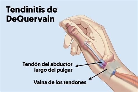 Tendinitis De Quervain Qu Es S Ntomas Causas Y Tratamiento Tua Sa De