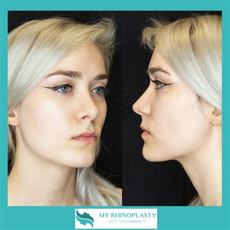 Naso Dritto My Rhinoplasty