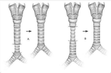 Tracheal Resection