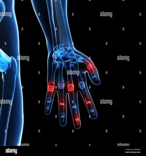 X-ray hand - arthritis Stock Photo - Alamy