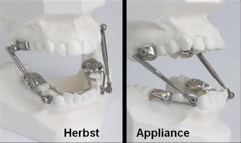 Orthodontic Appliances