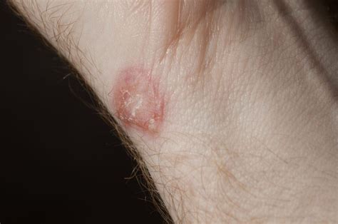 How To Get Rid Of Ringworm In Humans