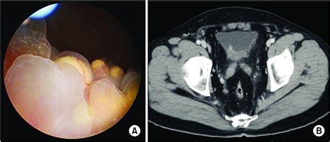 typical findings  extensive type cystitis glandularis  cystoscopy