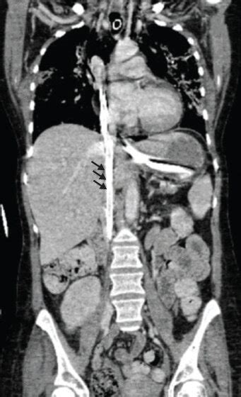 Preoperative Computed Tomography Angiography Cta Confirming The