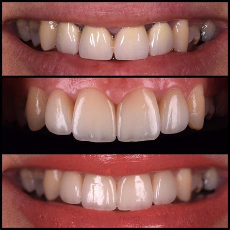 Replacement Of Dull Metal Ceramic Crowns This Time With Zirconia Based