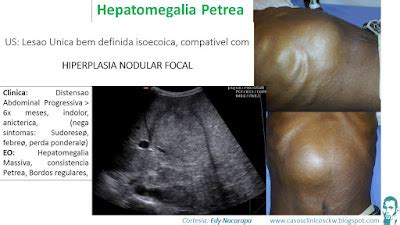 Casos Clinicos Fnh Hiperplasia Nodular Focal