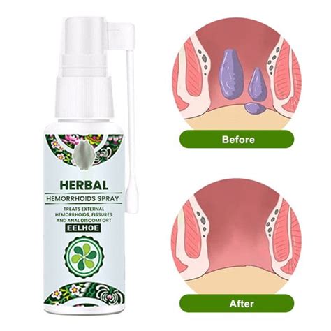 Natural Herbal Hemorrhoids Spray 30ml Pain Relief No Stimulation