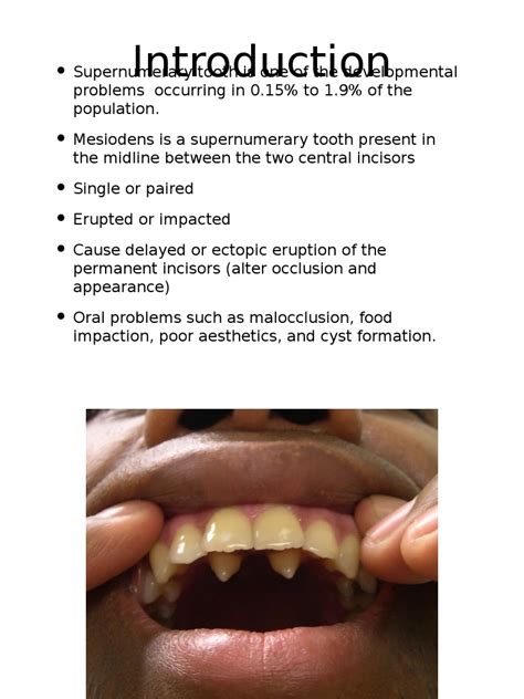 Supernumerary Tooth | PDF