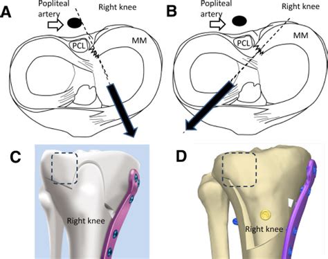 Combined Procedure Of Arthroscopic Pullout Medial Meniscal Root Repair