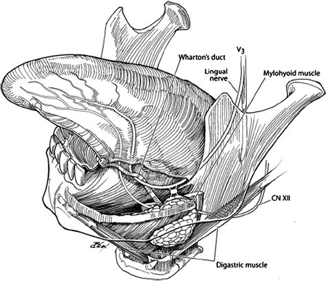 Trans Oral Submandibular Gland Removal Operative Techniques In