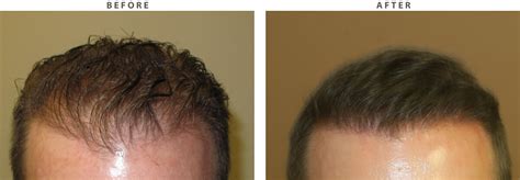 Excellent Month FUE Hair Transplant Result Case Study Sara 57 OFF