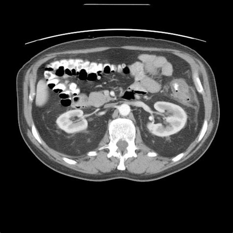 Diverticulitis Ct Wikidoc