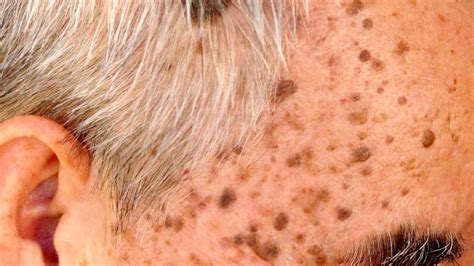 Seborrheic Keratosis Causes Symptoms And Treatment Cmsd