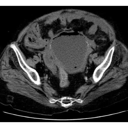 Upright Chest Plain Radiograph X Ray Showing Free Air Gas Under