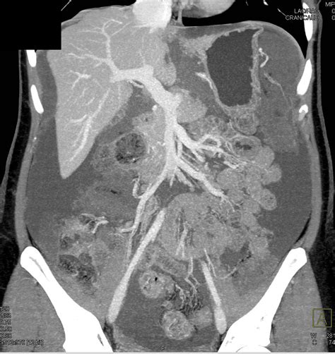 Pseudomyxoma Peritonei Pmp With Extensive Tumor And Scalloping Of The