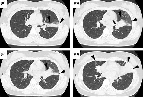 Simple Chest Computed Tomography Scan Obtained On Admission Lung