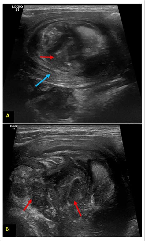 Ultrasound images (A, B) showing an epigastric mass of 4x6cm with ...