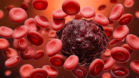 Understanding Blood Cancer Types Symptoms Diagnosis And Treatments