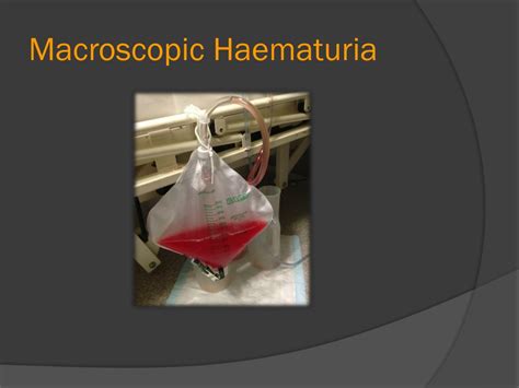 PPT - Haematuria PowerPoint Presentation, free download - ID:2309240