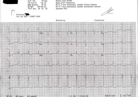 Rare, Abnormal EKG for 26yr old Female : r/EKG