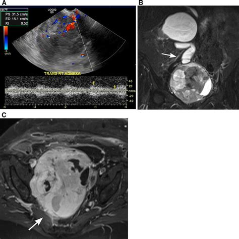 71 Year Old Woman With Malignant Solitary Fibrous Tumor Of The