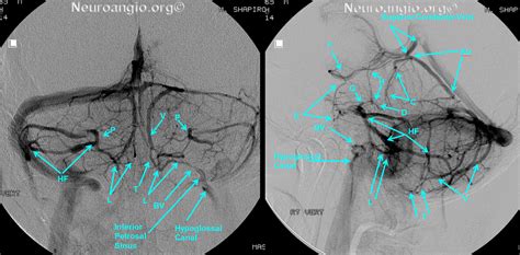 Bridging Vein (anterior brainstem group) | neuroangio.org